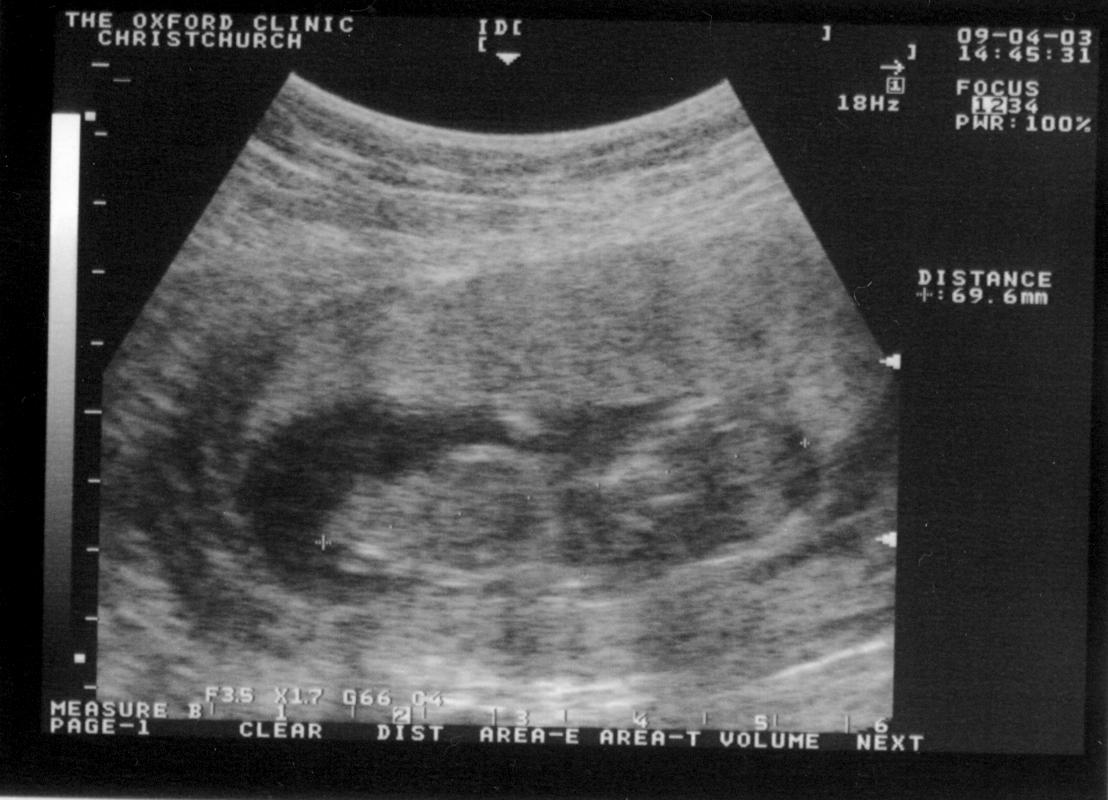 Baby/2003-00/2003-04-09_scan2_OxfordClinic.jpg